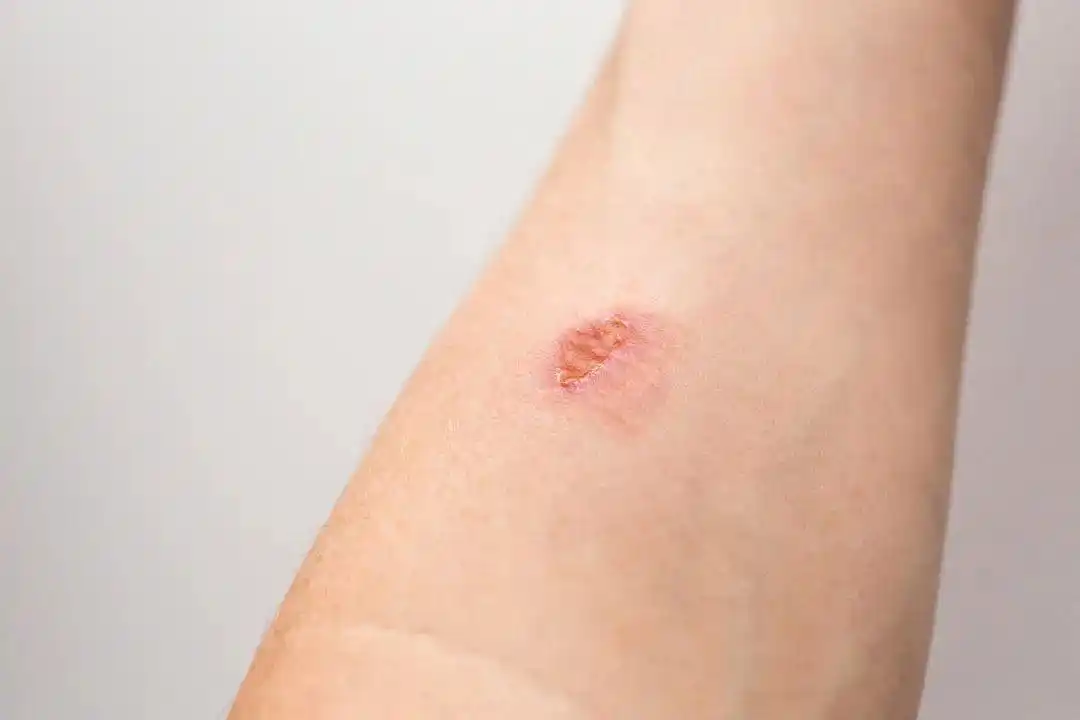 红霉素软膏千万不能随便用_红霉素软膏滥用场景_红霉素软膏正确使用方法