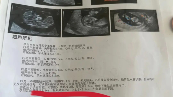 奇!每次产检都发现多出一胎!孕妇两个月内从一胎变四胞胎!医生:同卵四胞胎